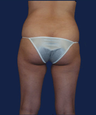 liposuction