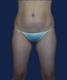 liposuction