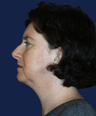 liposuction
