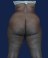 liposuction