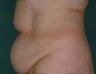 Lipo to Tummy