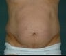 Liposuction