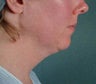 Lipo to Underchin