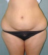 Liposuction