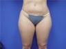 Liposuction