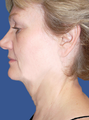 Jawline / Neck Lipo