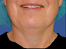 Jawline / Neck Lipo