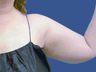 Liposuction Upper Arm