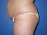 liposuction and buttocks fat grafting