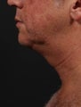 Neck Liposuction