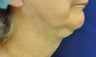 Neck Liposuction