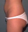 Liposuction