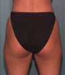 Liposuction