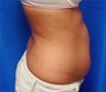 Liposuction