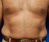 Liposuction