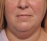 Neck Liposuction