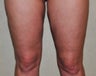 Knee Liposuction