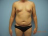 Liposuction