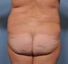 Flank Liposuction