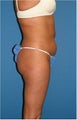 Liposuction