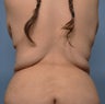 Liposuction