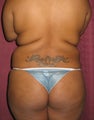 Back Liposuction