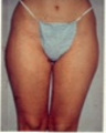 Liposuction