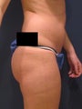 Liposuction