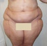 Liposuction Abdomen and Thighs