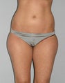 Liposuction