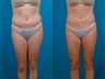 Liposuction