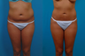 Liposuction