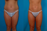 Liposuction