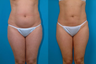 Liposuction