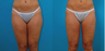 Liposuction