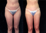 Liposuction