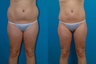 Liposuction