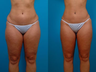 Liposuction