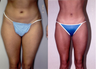 Liposuction