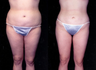 Liposuction
