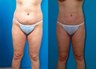 Liposuction