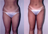 Liposuction