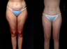 Liposuction