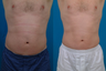 Liposuction