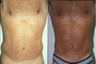 Liposuction