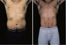 Liposuction