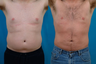 Liposuction