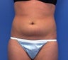 Liposuction