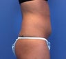 Liposuction