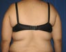Liposuction